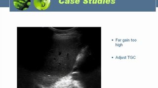 Ultrasound of liver part 3
