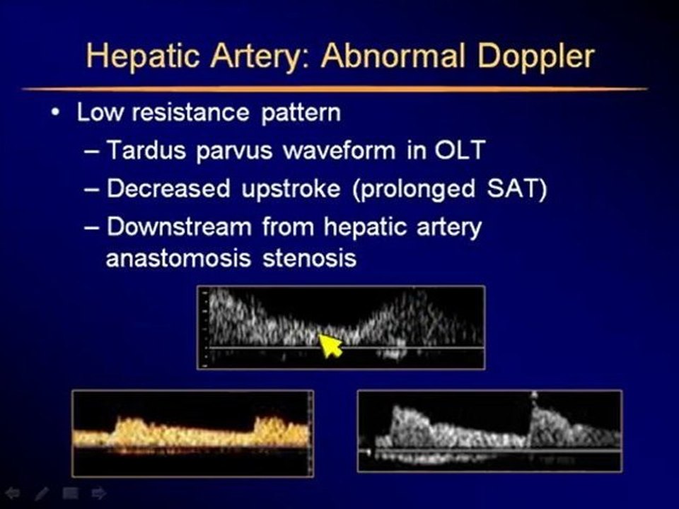 Ultrasound of the Liver part 4