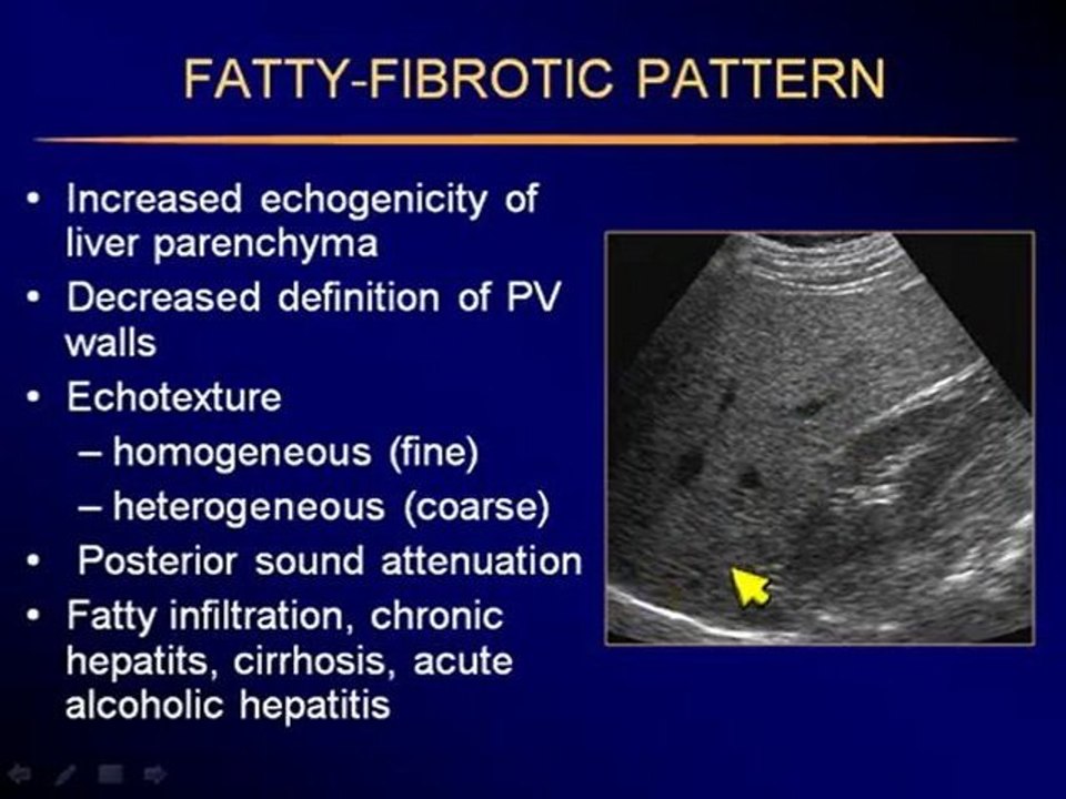 Ultrasound of the Liver part 5