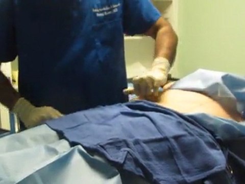 SmartLipo Laser Liposuction- Los Angeles County-Orange County-Riverside County-San Bernardino County-Inland Empire-Anaheim-Fullerton-Beverly Hills-Pasadena-Burbank-Hollywood-Cerritos-Long Beach-Irvine-Costa Mesa-Orange-Brea-Whittier-Pomona-Chino-Fontana