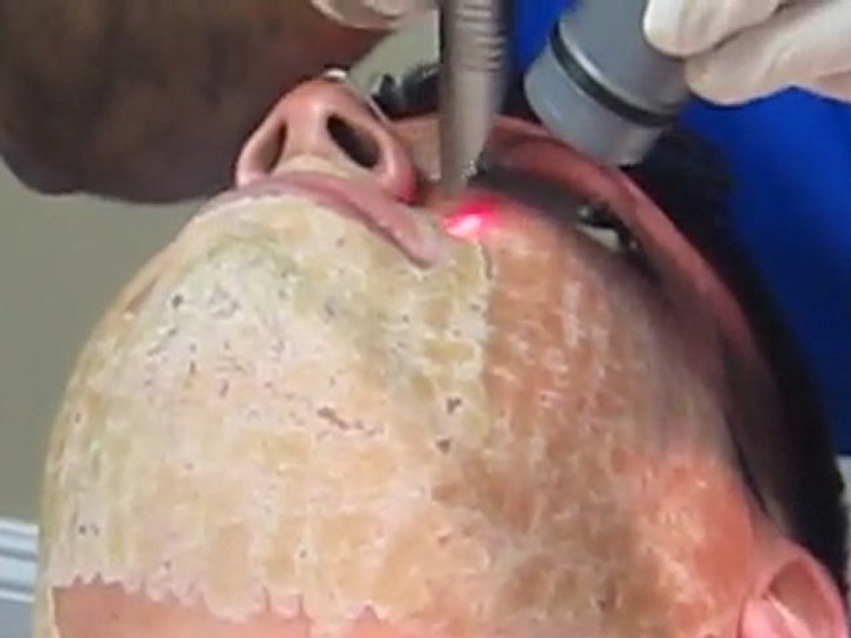 Acne Scar Removal-Erbium laser-Los Angeles County-Orange County-San Bernardino County-Anaheim-Irvine-Fullerton-Pasadena-Burbank-Cerritos-Rowland heights-Whittier-Covina-Chino Hills