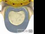 Cervical Spine Pathology Inter-vertebral Disc Annular Circumferential Tear litigation graphics
