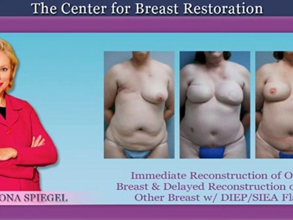 DIEP Flap Before and After Photos in Houston