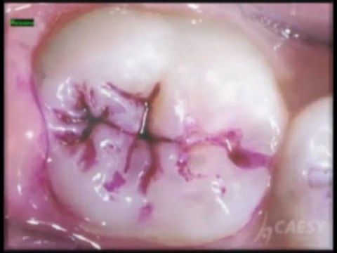 Dentist Glendale CA, What Are Dental Sealants? Dr. Kamran Sahabi