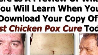 chicken pox rash - chicken pox shingles - chicken pox remedies