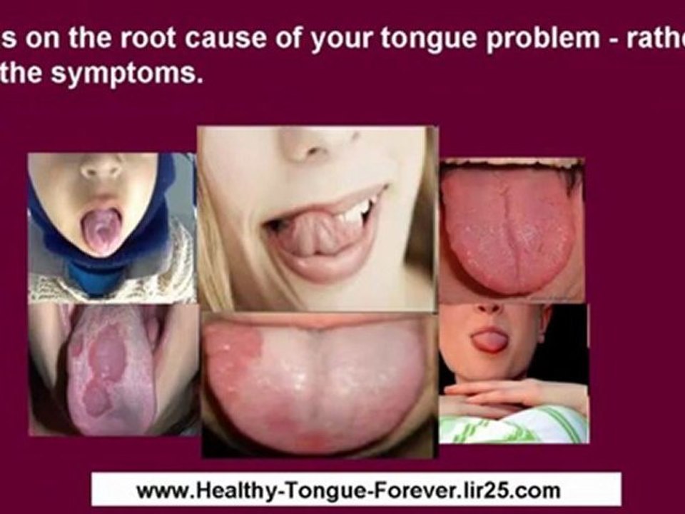 thrush symptoms in women - thrush symptoms in men - thrush symptoms in adults