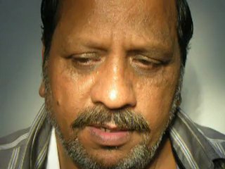 Get hair transplant in Lahore / Find hair transplant cost in Lahore