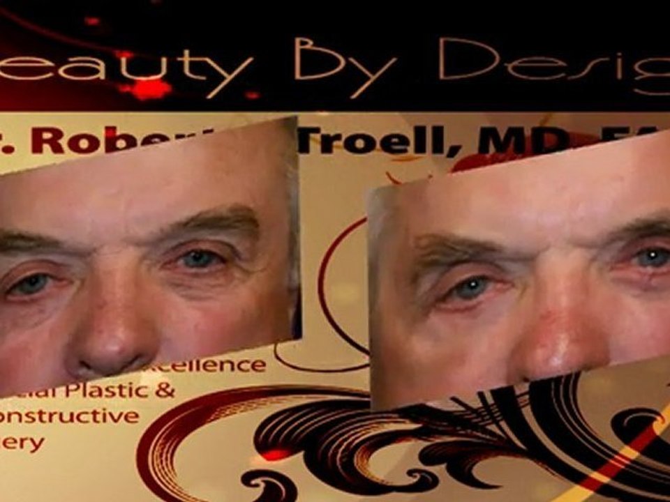 Mid Face Lift in Las Vegas by DrTroell.Com