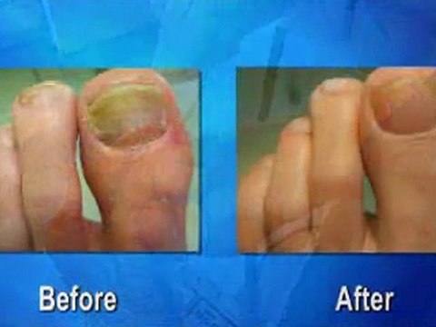 Laser Therapy for Fungal Toenails - Podiatrist Toronto, ON