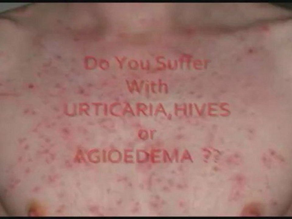 Natural Remedy For Urticaria
