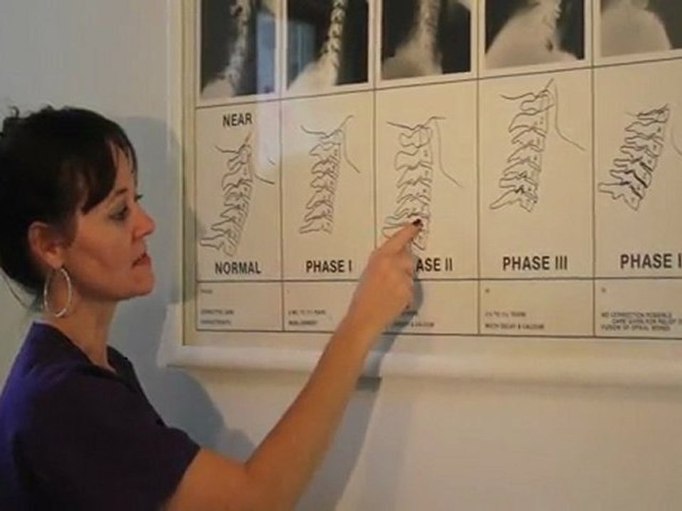How our spine degenerates over time - Chiropractor ...