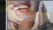Teeth Whitening Waukegan IL - Tooth Bleaching Waukegan IL - Waukegan IL Cosmetic Dentist