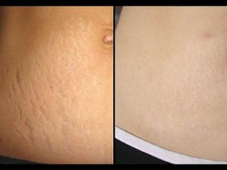 Como Eliminar Las Estrias