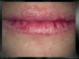 Lip Fusion Reviews | Lip Fusion Lip Plumper Scam