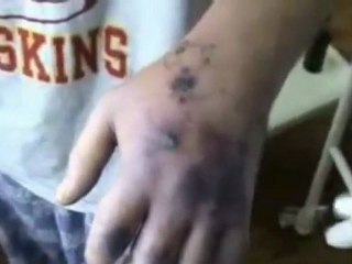 Drogue Krokodil : ses effets