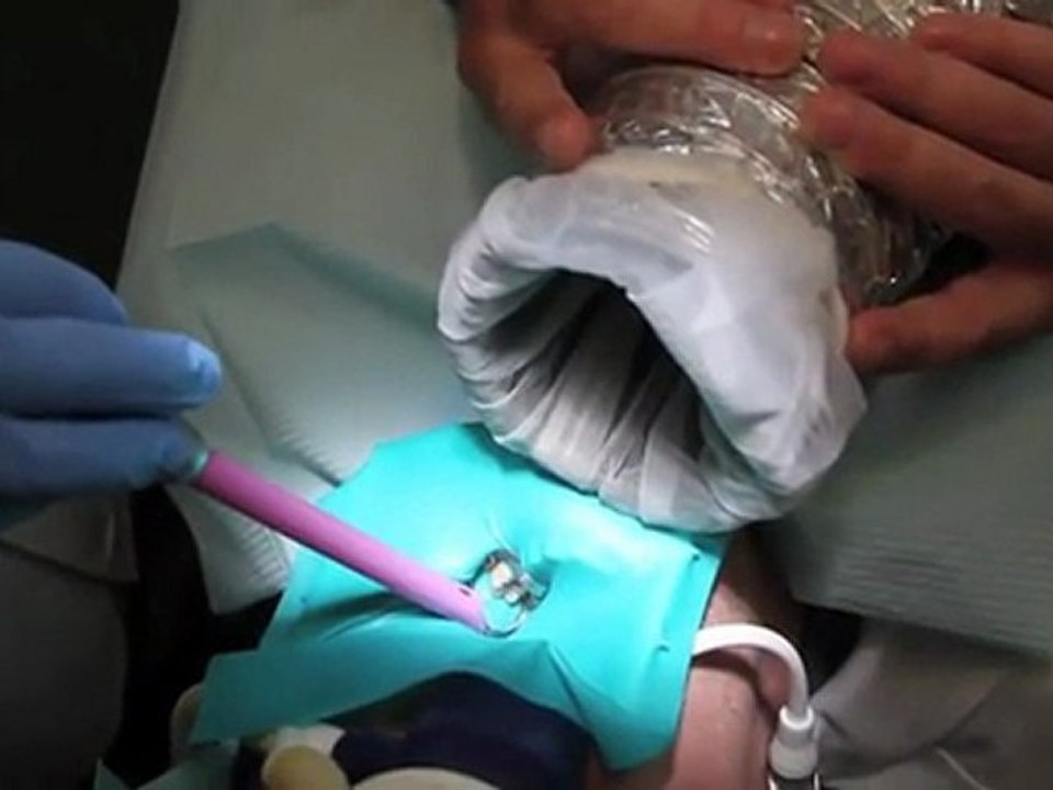 Safe Mercury Removal | Natural Dentistry San Diego