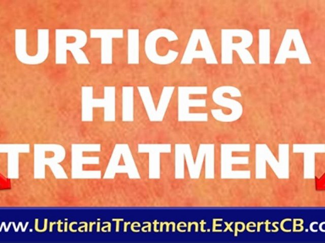 Angioedema treatment – treatment for hives