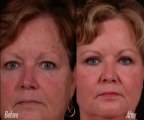 Eyelid Surgery - Melbourne Florida Plastic Surgeon, Dr. Guy