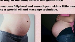 natural stretch mark removal - best stretch mark removal