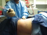 SmartLipo Laser Liposuction- Los Angeles County-Orange County-Riverside County-San Bernardino County-Inland Empire-Anaheim-Fullerton-Beverly Hills-Pasadena-Burbank-Hollywood-Cerritos-Long Beach-Irvine-Costa Mesa-Orange-Brea-Whittier-Pomona-Chino-Fontana