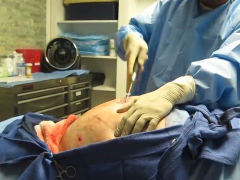 Liposuction-Laser Liposuction-SmartLipo Laser Liposuciton-Love Handles Liposuction