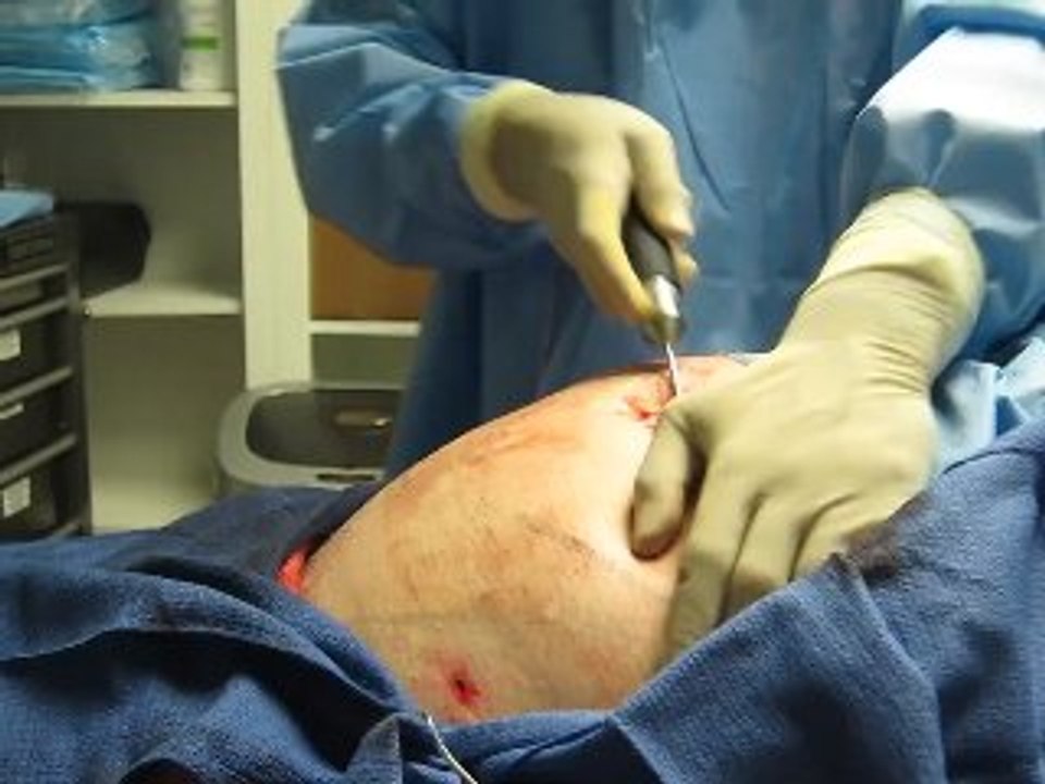 Liposuction-SmartLipo-Laser Liposuction-Abdominal Liposuction