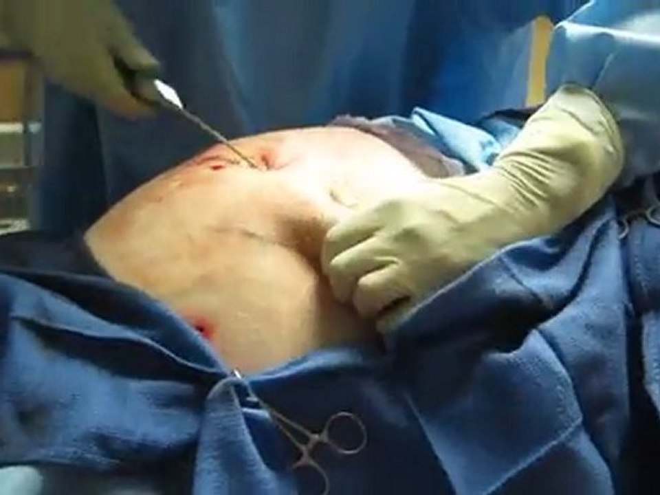 Laser Liposuction-SmartLipo-Abdomen Liposuction-Flanks Liposuction-Love Handles Liposuction