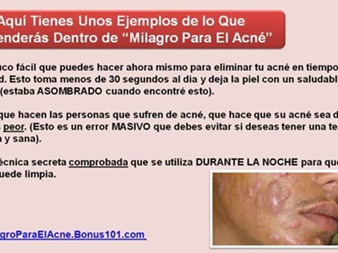 como quitar las espinillas - como quitar los granos de la cara - acne tratamiento casero