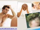 milagro para el cabello - como evitar la calvicie - tratamiento calvicie