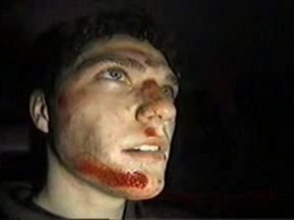 Bam Margera Skateboard Accident