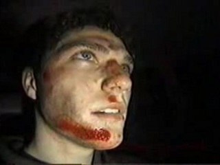 Bam Margera Skateboard Accident