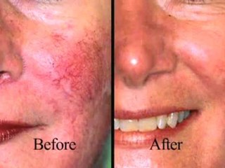 Aesthetic Medicine Minute with Dr. Darm by NW32-Rosacea