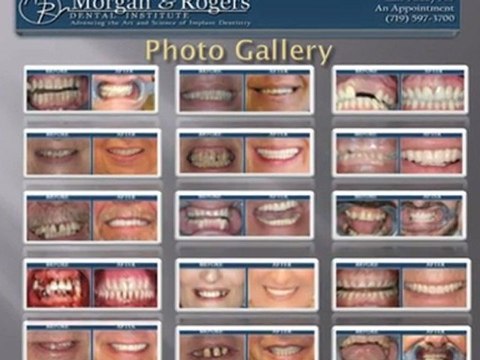 About dental Implant dentists in Colorado Springs