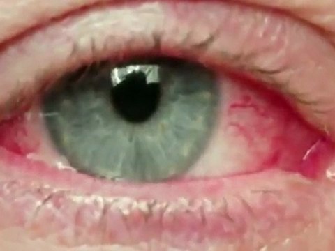 Treatment Mold Sickness (855) 800-6653