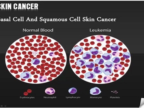 Melanoma Excision & Skin Cancer Treatment - Skin Cancer Los Angeles