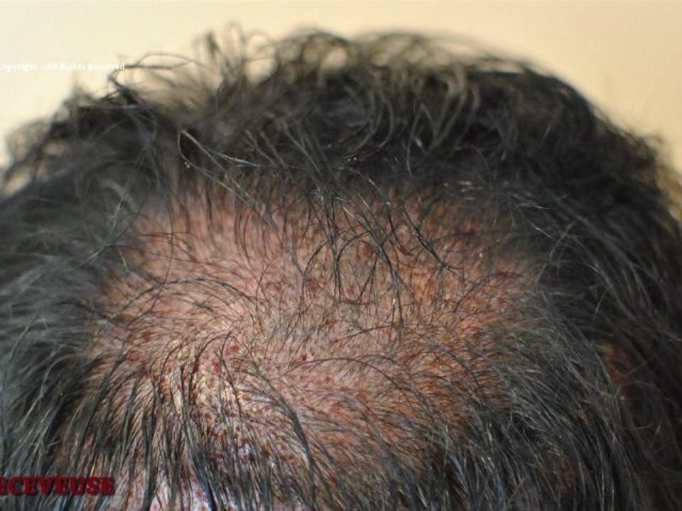 FUE_3331_Ufs_By_MEDIKEMOS_HAIR_TRANSPLANTATION_FR