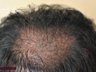 FUE_3331_Ufs_By_MEDIKEMOS_HAIR_TRANSPLANTATION_FR