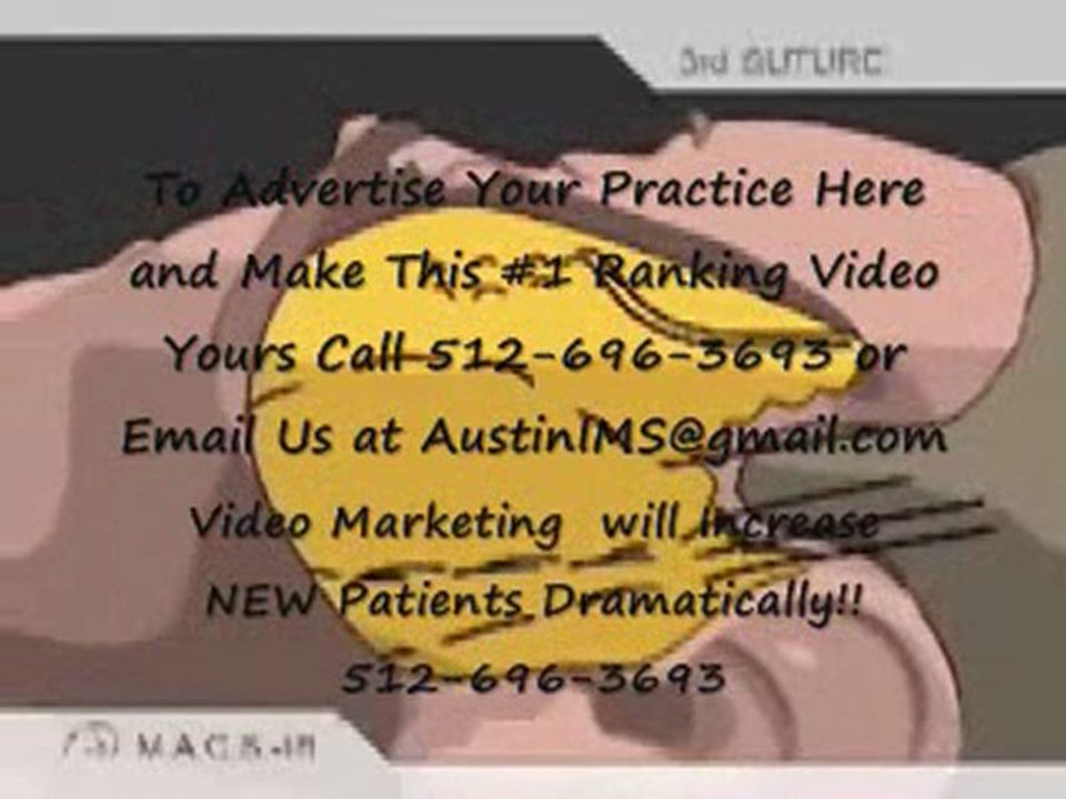 Tummy Tuck Austin - Plastic Surgeon in Austin, TX