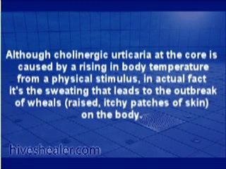 Cholinergic Urticaria