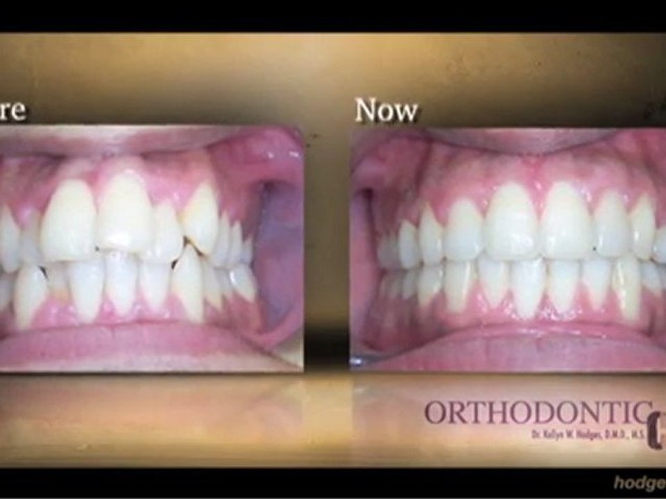 Braces Philadelphia - Bala Cynwyd, Bensalem & Montgomeryville