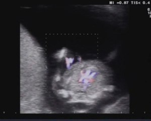Aloka - Increased nuchal translucency