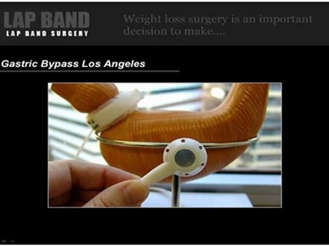 Lap Band & Body Lift Surgery Los Angeles - Gastric Bypass Surgery