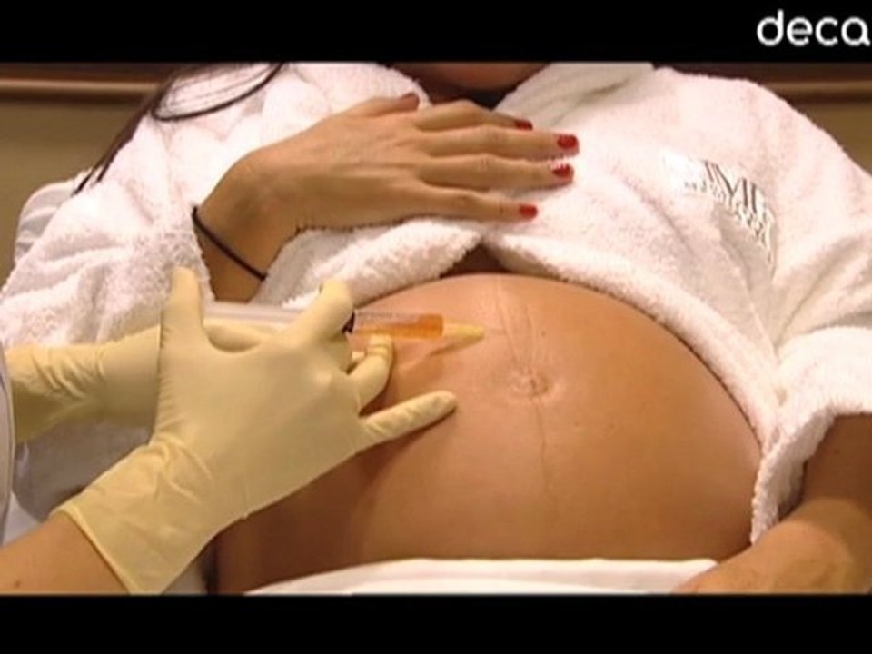 Prevenir estrías en el embarazo