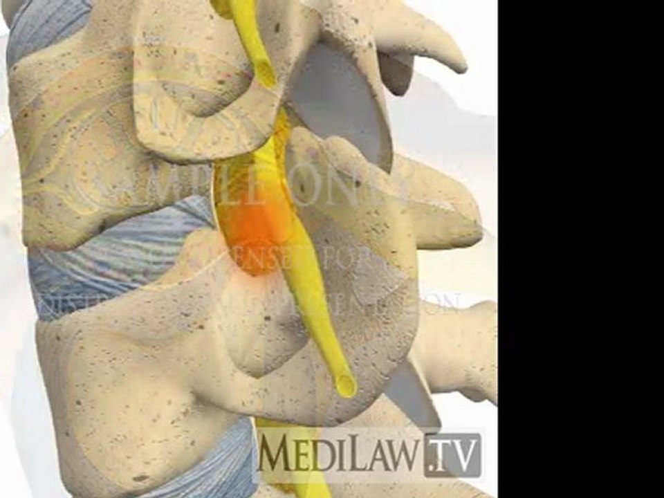 Cervical Spine Pathology Intervertebral Disc Sequestration orthopedic artwork
