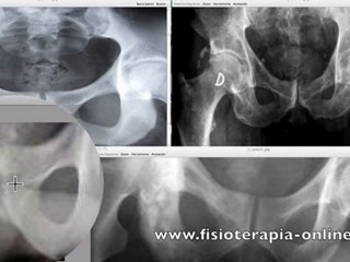 Osteopatía de pubis. Signos radiológicos.