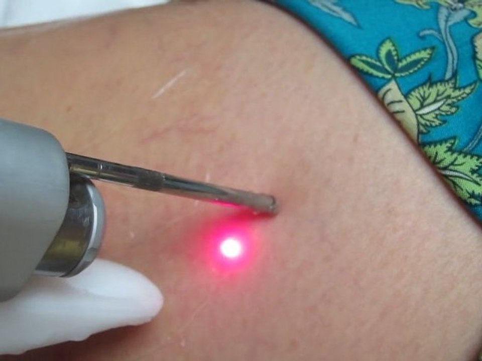 Spider Vein Laser Treatment- Los Angeles County-Orange County-Riverside County-San Bernardino County-Inland Empire-Anaheim-Fullerton-Beverly Hills-Pasadena-Burbank-Hollywood-Cerritos-Long Beach-Irvine-Costa Mesa-Orange-Brea-Whittier-Pomona-Chino-Fontana