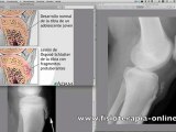 Enfermedad de Osgood-Schlatter o Crecederas. Signos ...