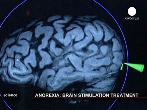 Une stimulation magnétique du cerveau contre l'anorexie