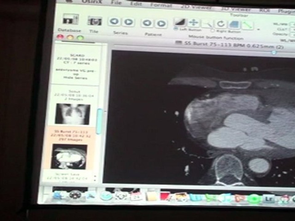 SERFATY Heart cases