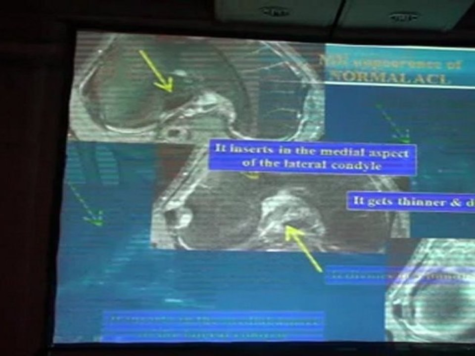 Traumatic Knee MRI LB